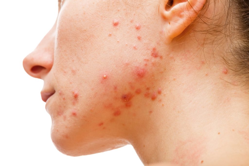 Various acne treatments are available in Cary at Azura Skin Care Center